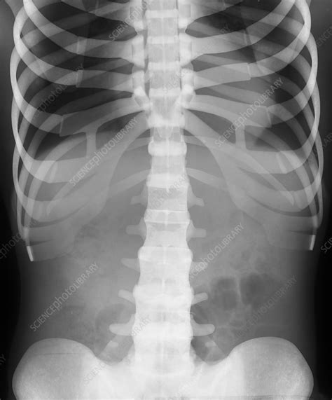 Human thorax, X-ray - Stock Image - C011/5763 - Science Photo Library