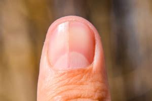 What Do Vertical Ridges On Nails Mean? Causes And Prevention