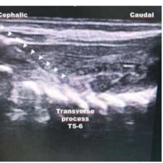 Ultrasound image of paravertebral block showing the needle (arrow head ...