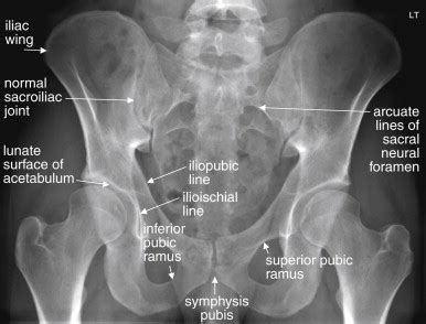 Imaging of the Pelvis and Hip | Radiology Key