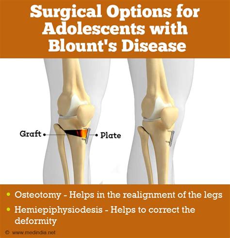 Blount’s Disease | Growth Disorder - Types, Causes, Symptoms, Diagnosis, Treatment and Prognosis