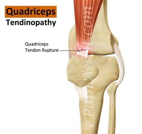 Quadriceps Tendinopathy | Quadriceps tendonitis, Sports injury, Tendonitis treatment