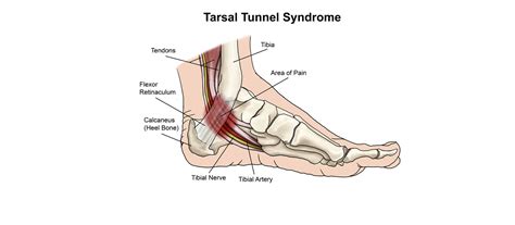 Tarsal Tunnel Syndrome: Symptoms, Causes, and Treatments | Dr. Geller