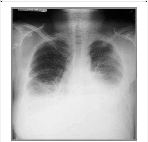 Lung Cancer Pleural Effusion