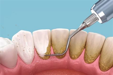 5 Tips to (Safely) Remove Plaque From Teeth