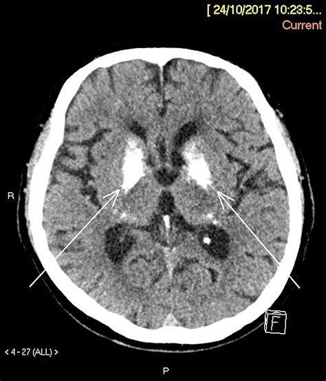 Cureus | Bilateral Basal Ganglia Calcification: Fahr's Disease