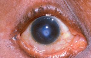 Corneal Ulcer: Causes, Symptoms, Diagnosis & Treatment » How To Relief