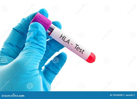 HLA test stock photo. Image of illness, attention, failure - 70336998