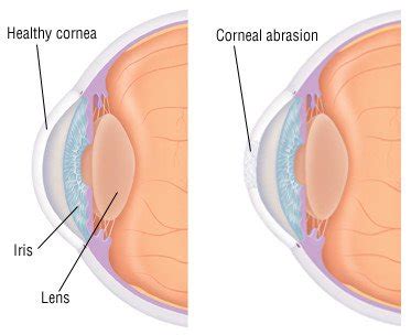 Corneal Abrasion Guide: Causes, Symptoms and Treatment Options