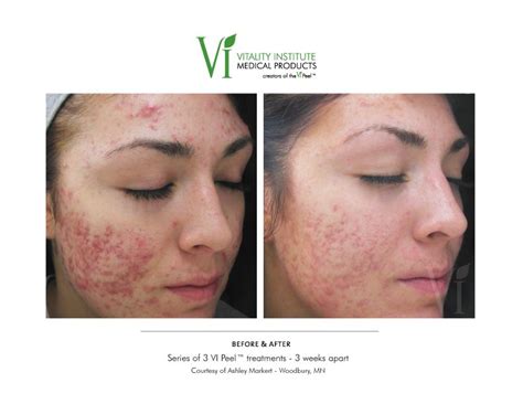 This patient had a series of 3 VI PEELS #vipeel, #skincare, #acne ...