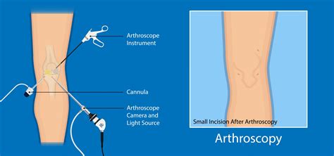 Knee Arthroscopy Reasons, Procedure & Benefits | Advanced Surgery Center