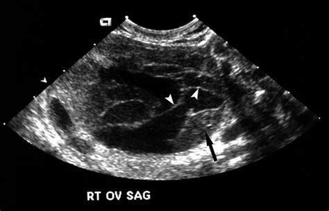 Sonographic Spectrum of Hemorrhagic Ovarian Cysts - Jain - 2002 ...