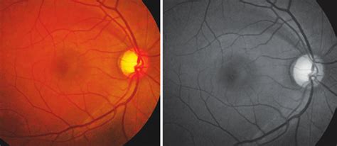 RNFL defect superior. Better seen in red free photograph below | Download Scientific Diagram