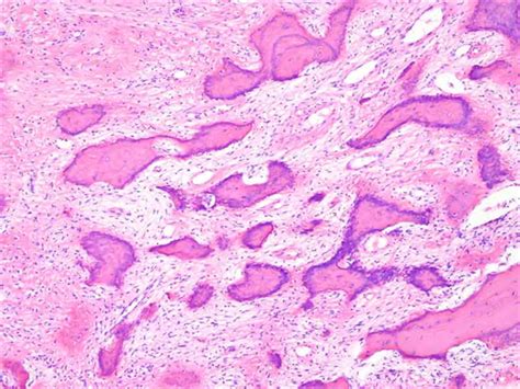 Parosteal Osteosarcoma - Pathology - Orthobullets