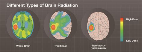 Supratentorial Brain Tumors: Symptoms, Diagnosis, Imaging Test, Risk Factors, and Treatment ...