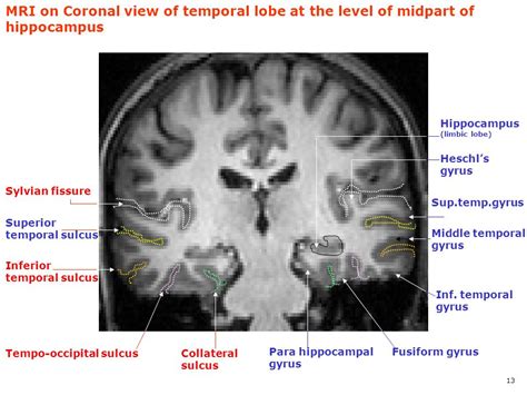 Parahippocampal Gyrus Mri