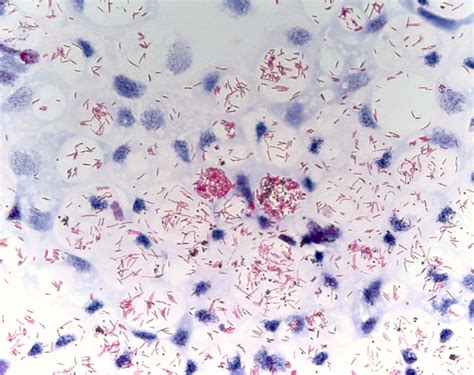 Acid Fast Staining Mycobacterium Tuberculosis