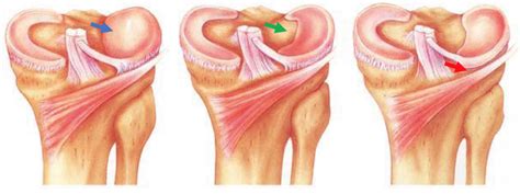 What is Discoid Meniscus? | David Slattery