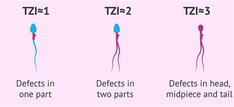 Teratospermia: definition, causes, symptoms and treatment – Healthy Food Near Me