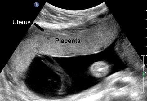 Prenatal diagnosis of morbidly adherent placenta - International Journal of Obstetric Anesthesia