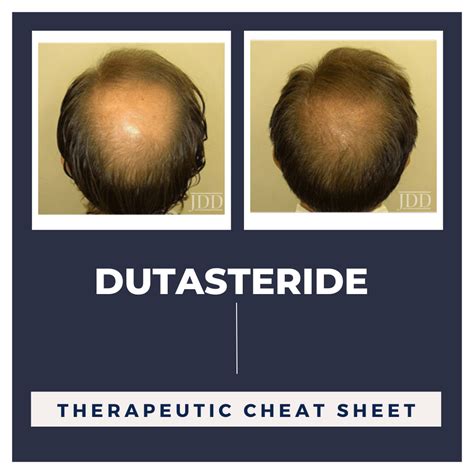 Dutasteride Dosage For Hair Loss - 2024 HairStyles Ideas