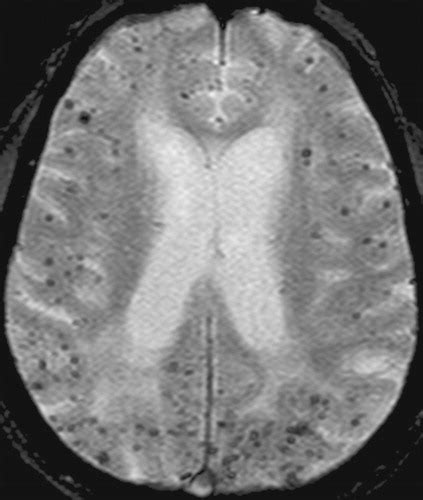 Cerebral Amyloid Angiopathy: CT and MR Imaging Findings | RadioGraphics