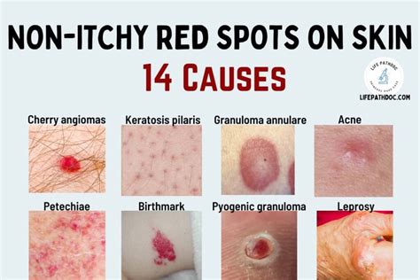 Red Spots On Skin 38 Causes Pictures And Treatment - vrogue.co