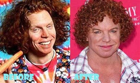 Carrot Top Plastic Surgery Before and After | Carrot top plastic surgery, Plastic surgery ...