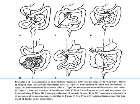 Malrotation
