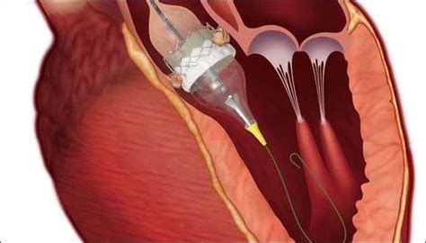 Mechanical heart valve could be safer for younger patients | Health News