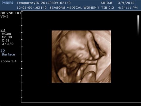 And this is my Joy: 17 weeks and an early ultrasound...