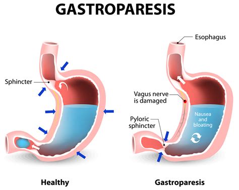 Gastroparesis - Causes, Symptoms, Diet, Medications & Treatment