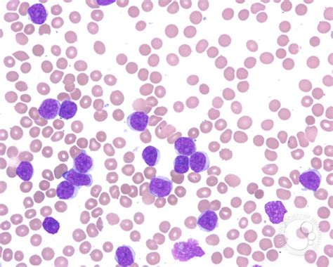 Peripheralizing Follicular Lymphoma with Atypical Morphology - 1.