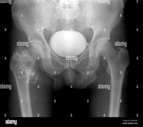 Bone cancer. X-ray of the pelvis of a 53 year old man with a chondrosarcoma (ornage) in the ...