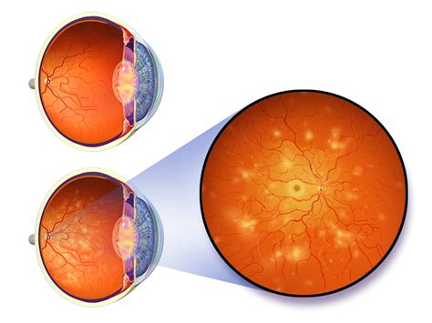 Nonproliferative diabetic retinopathy | Eye Disorders and Diseases articles | Body & Health ...