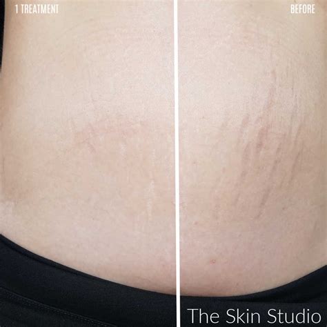 The Best Treatment for Stretch Marks - The Skin Studios