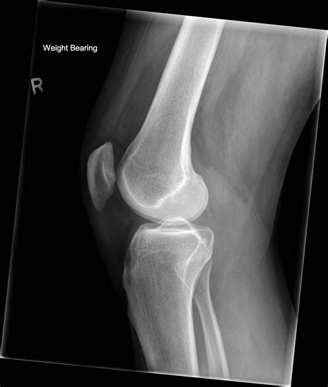 List 102+ Pictures What Does A Normal Knee Xray Look Like Stunning