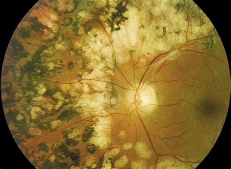 Ophthalmologists Vital in Mitigating Systemic Risks for Patients With ...