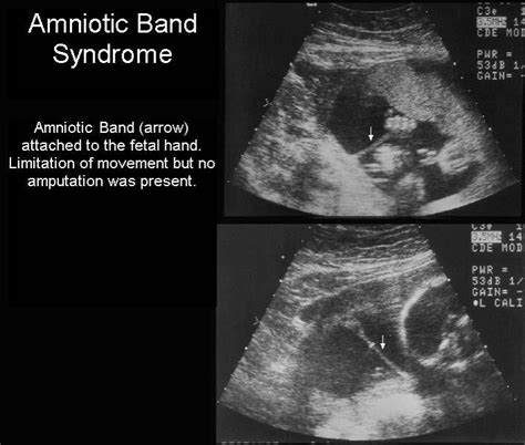 Amniotic Band Syndrome (ABS) | Ultrasound, Obstetric ultrasound, Ultrasound sonography