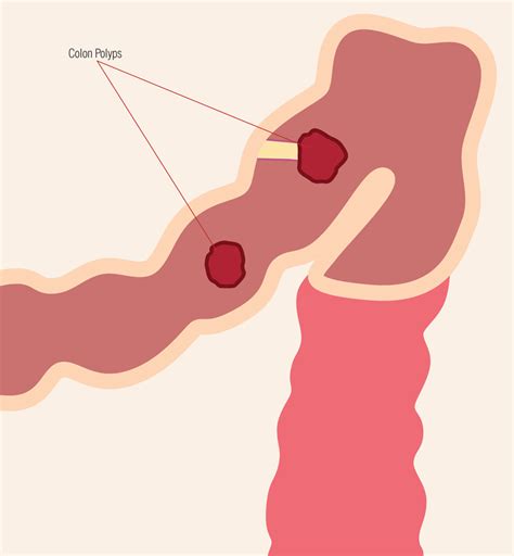 Colonic Polyps treatment from Exeter Gut Clinic | Exeter Gut Clinic