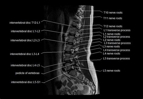 MRI spine anatomy | free MRI lumbar spine sagittal cross sectional anatomy | Mri, Anatomy images ...