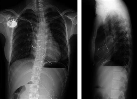 Chest X-ray taken 7 years after transvenous pacemaker implantation when ...