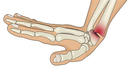 Smith's Fracture - Symptoms, Causes, Treatment & Surgery