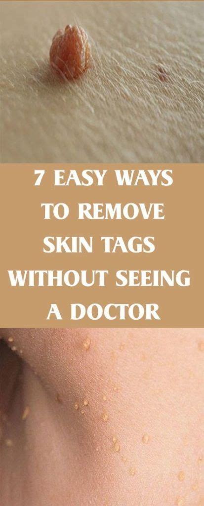 How to Remove Moles, Warts, Blackheads, Skin Tags, and Age Spots Completely Naturally! in 2020 ...