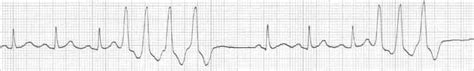 Adult. EKG for nurses exam – Floridian CE Courses