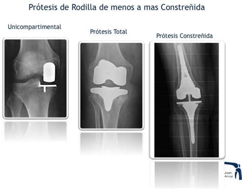 Guarda la ropa diapositiva desaparecer precio de protesis de rodilla en ...