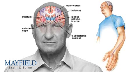 Parkinson's disease affects nerve cells deep in the brain responsible ...