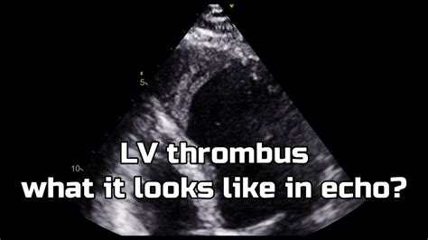 Apical thrombus (Left ventricle) - YouTube