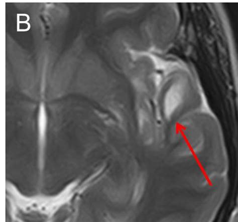 Neuroglial cyst – Radiology Cases