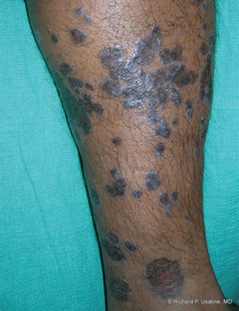 What Is Lichen Planus? What Are Its Causes And Symptoms?, 43% OFF